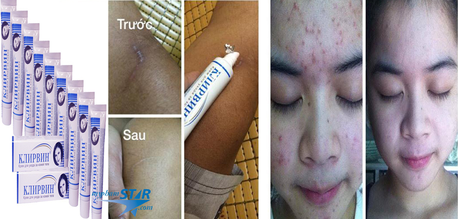Kem trị rạn, trị sẹo lồi, lõm, do mụn và vết thương Klirvin- Nga