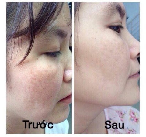 KEM VUA KHỬ NÁM SIÊU TRẮNG CHỐNG NẮNG TÀN NHANG NHẬT BẢN